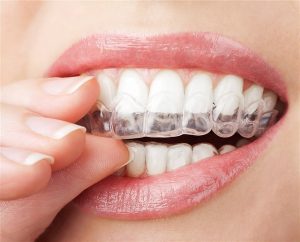 How Often Should You Visit Your Orthodontist When Weaing Invisalign - Wonder West Orthodontics